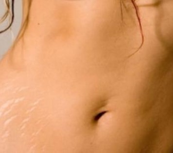 Natural cream for the prevention and treatment of stretch marks